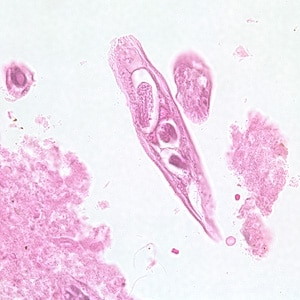 Figure B: Longitudinal section of an adult of <em>C. philippinensis</em> from an intestinal biopsy specimen stained with hematoxylin and eosin (H&E).