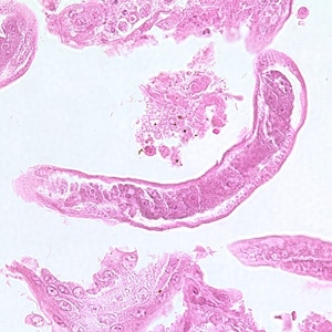 Figure A: Longitudinal section of an adult of <em>C. philippinensis</em> from an intestinal biopsy specimen stained with hematoxylin and eosin (H&E).