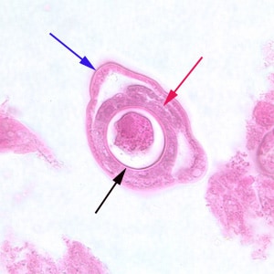 Figure E: Cross-section of a gravid adult female <em>C. philippinensis</em> from an intestinal biopsy specimen, stained with H&E. Shown in this figure are a bacillary band (blue arrow), the intestine (red arrow) and uterus containing an egg in cross-section (black arrow).