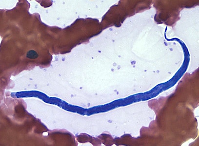 Figure E: Microfilaria of <em>L. loa</em> in a thin blood smear, stained with Giemsa.