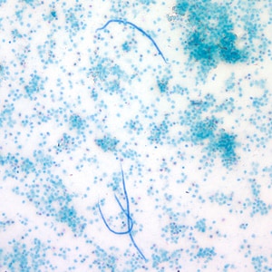 Figure G: Microfilariae of <em>L. loa</em> captured by the Knotts concentration technique. Image taken at 100x magnification.