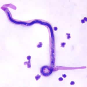 Figure A: Microfilaria of <em>B. malayi</em> in a thick blood smear, stained with Giemsa.
