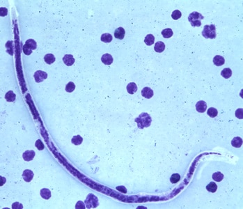 Figure E: Microfilaria of <em>B. timori</em> in a thick blood smear from a patient from Indonesia, stained with Giemsa and captured at 500x oil magnification. Image from a specimen courtesy of Dr. Thomas C. Orihel, Tulane University, New Orleans, LA.