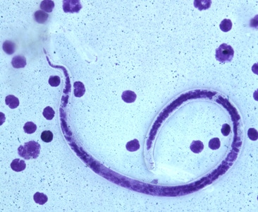 Figure F: Microfilaria of <em>B. timori</em> in a thick blood smear from a patient from Indonesia, stained with Giemsa and captured at 500x oil magnification. Image from a specimen courtesy of Dr. Thomas C. Orihel, Tulane University, New Orleans, LA.