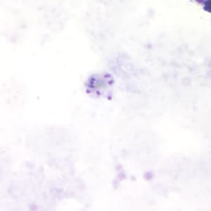 Figure B: Schizont of <em>P. malariae</em> in a thick blood smear.