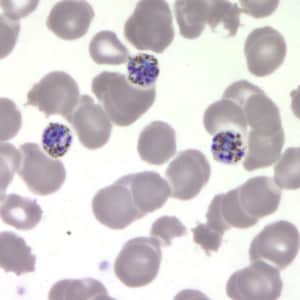 Figure E: Schizonts of <em>P. malariae</em> in a thin blood smear.