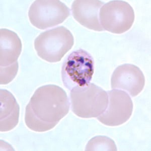 Figure F: Schizont of <em>P. malariae</em> in a thin blood smear.