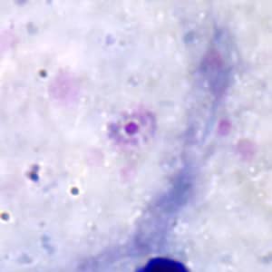 Figure A: Ring-form trophozoite of <em>P. ovale</em> in a thick blood smear.