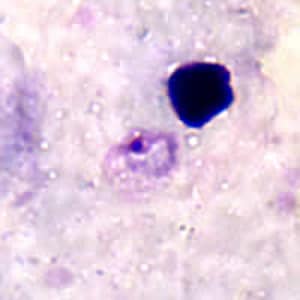 Figure B: Ring-form trophozoite of <em>P. ovale<em> in a thick blood smear.