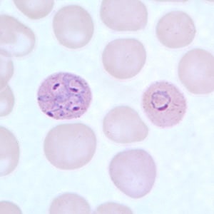Figure C: Ring-form trophozoites of <em>P. ovale</em> in a thin blood smear. Note the multiply-infected RBC in this image.
