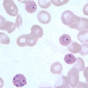 Figure E: Ring-form trophozoites of <em>P. ovale</em> in a thin blood smear. Note the multiply-infected RBC in this image.