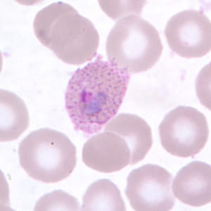 Figure C: Trophozoite of <em>P. ovale</em> in a thin blood smear. Note the fimbriation and Schüffner's dots.