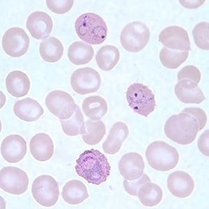 Figure F: Infected RBCs showing developing (lower) and ring-form (upper two) trophozoites of <em.P. ovale</em> in a thin blood smear.