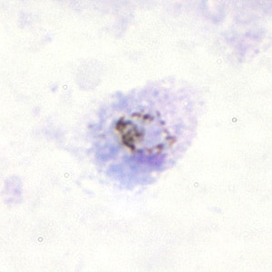 Figure A: Gametocyte of <em>P. ovale</em> in a thick blood smear.