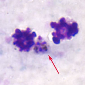 Figure B: Gametocyte of <em>P. ovale</em> (red arrow) nestled between two white blood cells in a thick blood smear.