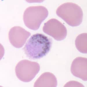 Figure D: Macrogametocyte of <em>P. ovale</em> in a thin blood smear. Note the fimbriation.