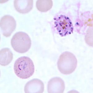 Figure G: Schizont (upper right) and ring-form trophozoite (lower left) of <em>P. ovale</em> in a thin blood smear.
