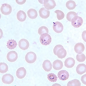 Figure F: Ring-form trophozoites of <em>P. falciparum</em> in a thin blood smear, exhibiting Maurer's clefts.