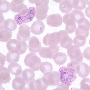 Figure C: Trophozoites of <em>P. vivax</em> in a thin blood smear. Note the amoeboid appearance, Schüffner's dots and enlarged infected RBCs.