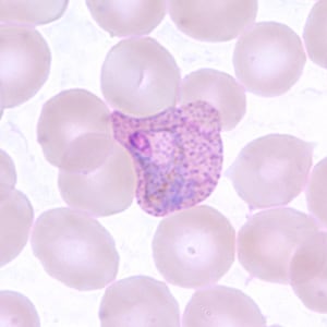 Figure D: Trophozoite of <em>P. vivax</em> in a thin blood smear. Note the amoeboid appearance, Schüffner's dots and enlarged infected RBCs.