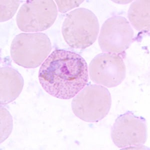 Figure E: Trophozoite of <em>P. vivax</em> in a thin blood smear. Note the amoeboid appearance, Schüffner's dots and enlarged infected RBCs.