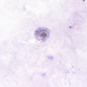 Figure B: Gametocyte of <em>P. vivax</em> in a thick blood smear.
