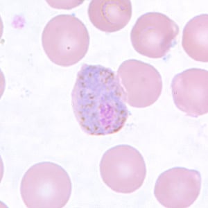Figure E: Macrogametocyte of <em>P. vivax</em> in a thin blood smear. Note the enlargement of the gametocytes compared to uninfected RBCs.