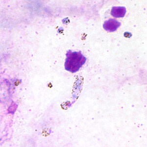 Figure A: Ookinete of <em>P. vivax</em> in a thick blood smear.
