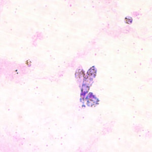 Figure B: Ookinete of <em>P. vivax</em> in a thick blood smear.