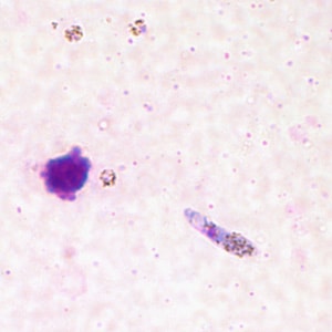 Figure C: Ookinete of <em>P. vivax</em> in a thick blood smear.