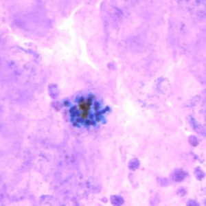 Figure C: Schizont of <em>P. vivax</em> in a thick blood smear.