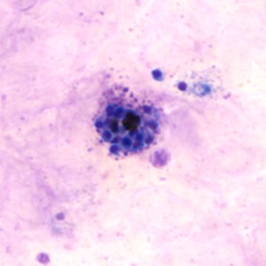 Figure E: Schizont of <em>P. vivax</em> in a thick blood smear.