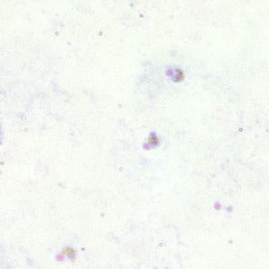 Figure A: Trophozoites of <em>P. falciparum</em> in a thick blood smear.