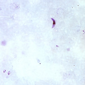 typical presentation of malaria