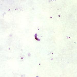 Figure B: Gametocytes of <em>P. falciparum</em> in a thick blood smear. Note also the presence of many ring-form trophozoites.