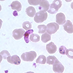 Figure E: Gametocyte of <em>P. falciparum</em> in a thin blood smear. Also seen in this image are ring-form trophozoites exhibiting Maurer's clefts.