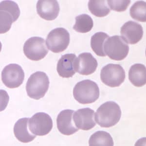 Figure B: Ring-form trophozoite of <em>P. knowlesi</em> in a Giemsa-stained thin blood smear from a human patient that traveled to the Philippines. Image courtesy of the Wadsworth Center, New York State Department of Health.