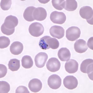 Figure B: Gametocyte of <em>P. knowlesi</em> in a Giemsa-stained thin blood smear from a patient that traveled to the Philippines. Note also a ring-form trophozoite in the lower left of this image. Image courtesy of the Wadsworth Center, New York State Department of Health.