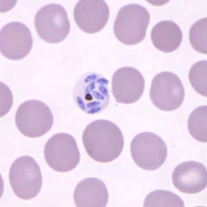 Figure A: Mature schizont in a Giemsa-stained thin blood smear from a patient that traveled to the Philippines.Images courtesy of the Wadsworth Center, New York State Department of Health.