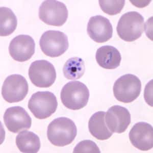 Figure B: Mature schizont in a Giemsa-stained thin blood smear from a patient that traveled to the Philippines. Note also a ring-form trophozoite to the right of the schizont in this figure. Images courtesy of the Wadsworth Center, New York State Department of Health.