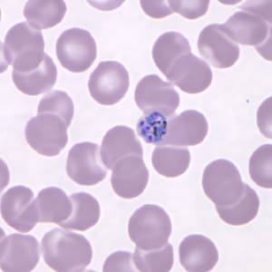 Figure C: Developing schizont in a Giemsa-stained thin blood smear from the same patient seen in Figures A and B.