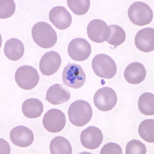 Figure D: Mature schizont in a Giemsa-stained thin blood smear from the same patient seen in Figures A-C.
