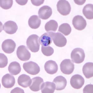Figure E: Developing schizont in a Giemsa-stained thin blood smear from the same patient as Figures A-D.