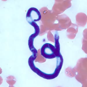 Figure E: Microfilaria of <em>M. perstans</em> in a thin blood smear from the same specimen as Figures A-D.