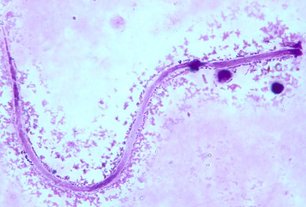 Figure A: Microfilaria of <em>M. ozzardi</em> in a thick blood smear, stained with Giemsa.