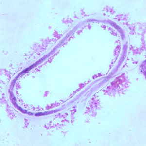 Figure B: Microfilaria of <em>M. ozzardi</em> in a thick blood smear, stained with Giemsa.