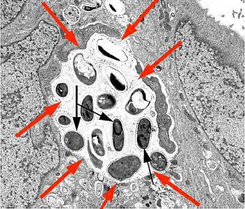 Figure D: Transmission electron micrograph of <em>E. intestinalis</em> depicting developing forms inside a parasitophorous vacuole (red arrows) with mature spores (black arrows).