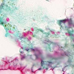 Figure A: Spores of <em>T. acridophagus</em> in BAL specimens, stained with Chromotrope 2R stain.