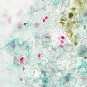 Figure B: Spores of <em>T. acridophagus</em> in BAL specimens, stained with Chromotrope 2R stain.