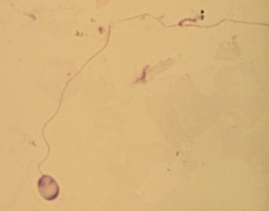 Figure B: A single microsporidia spore from the same case as Figure A, stained with Giemsa. In this image, the polar tubule has been extruded.